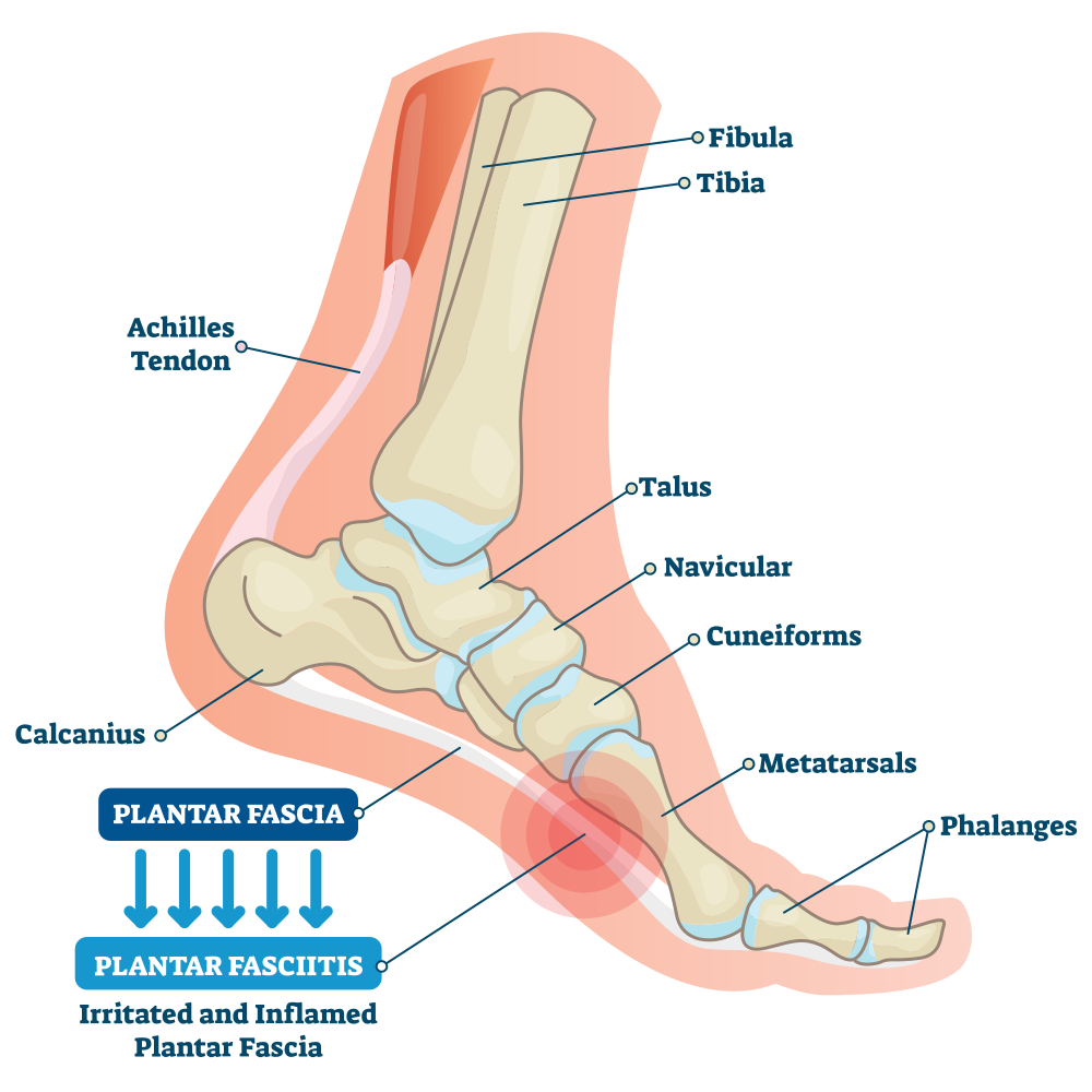 What's the Difference Between Plantar Fasciitis and Heel Spurs? - Northern  Nevada Chiropractic